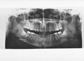 Erä röntgefilmikuvia 5 kpl 15x30  cm laite-esittelykuvia
