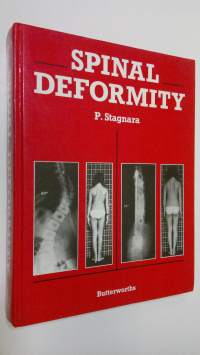 Spinal Deformity