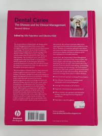Dental caries : the disease and its clinical management